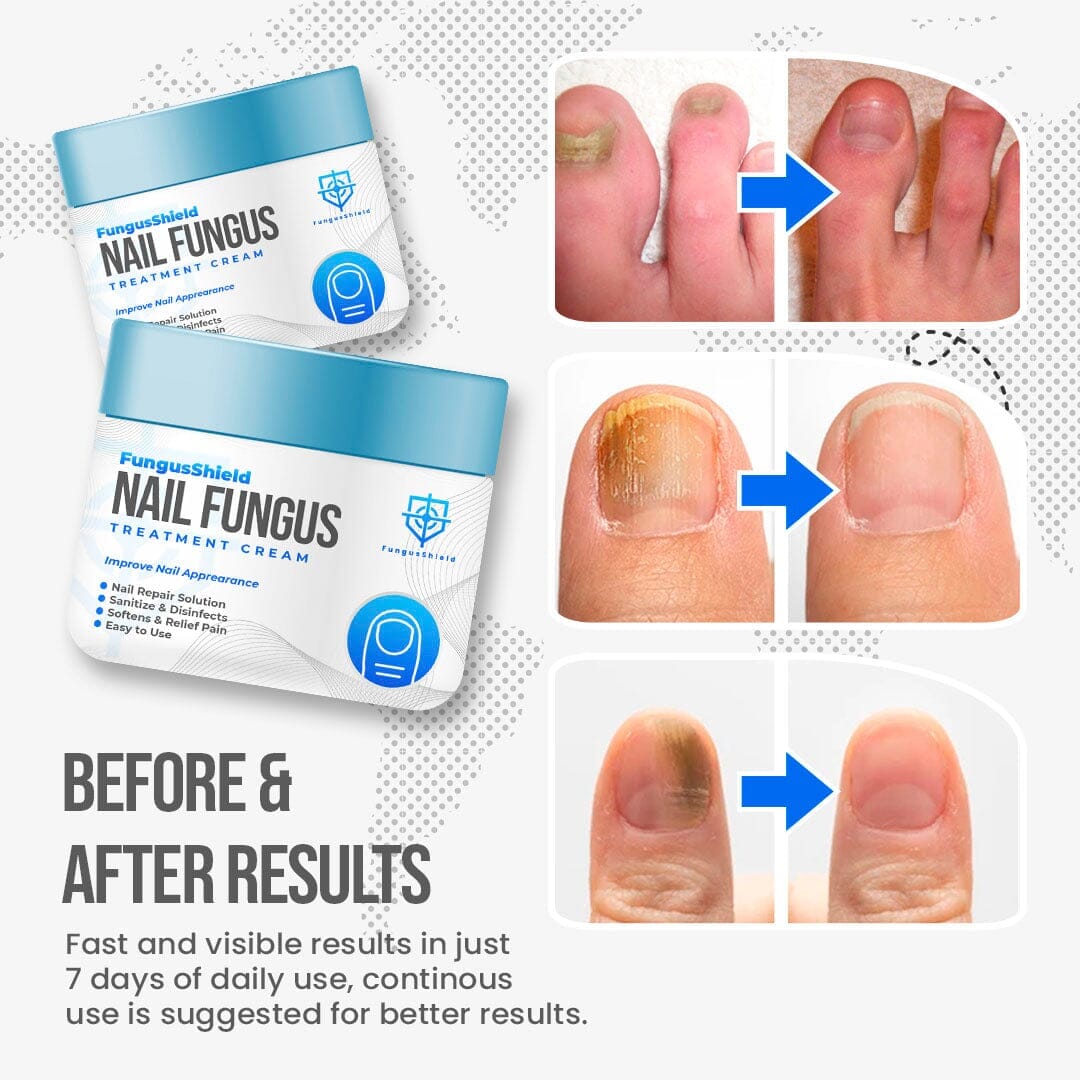 🛡️FungusShield Nail Treatment Cream